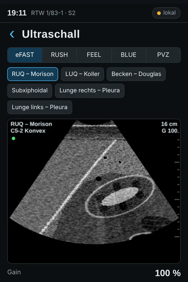 SimOn-Handheld mit Ultraschallbild des rechten Oberbauchs