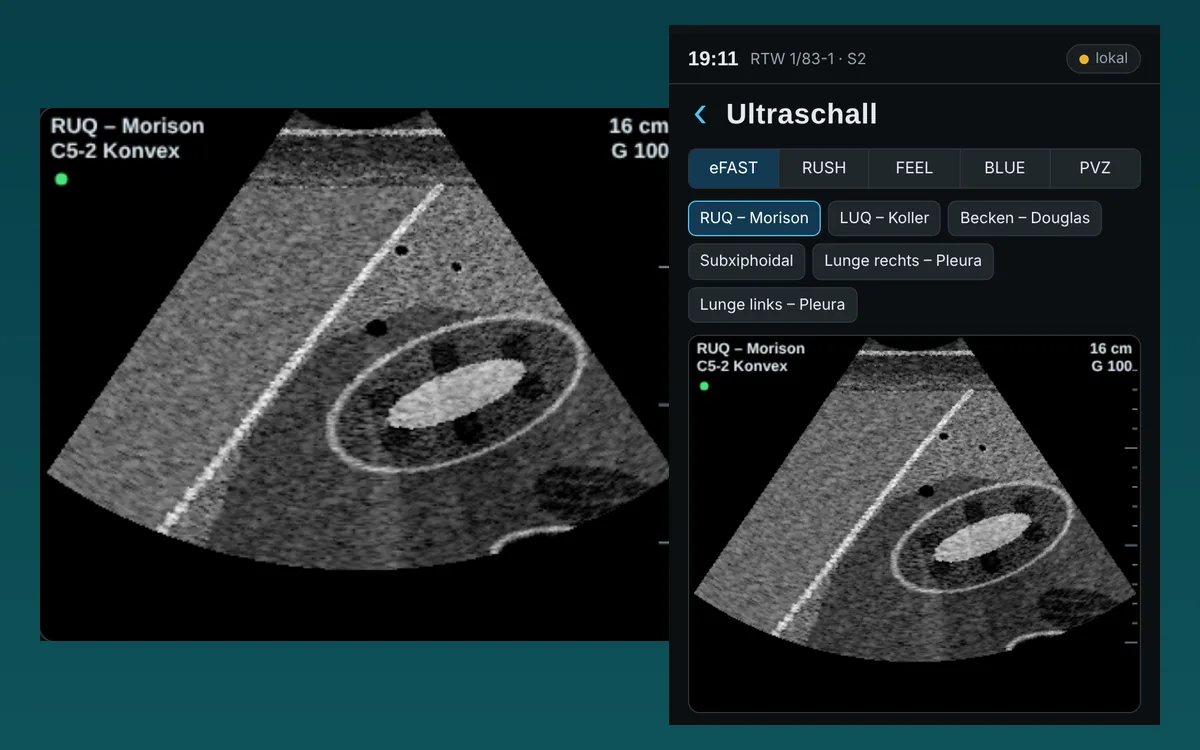 Ultraschall im SimOn-Handheld mit eFAST-Schnittebenen